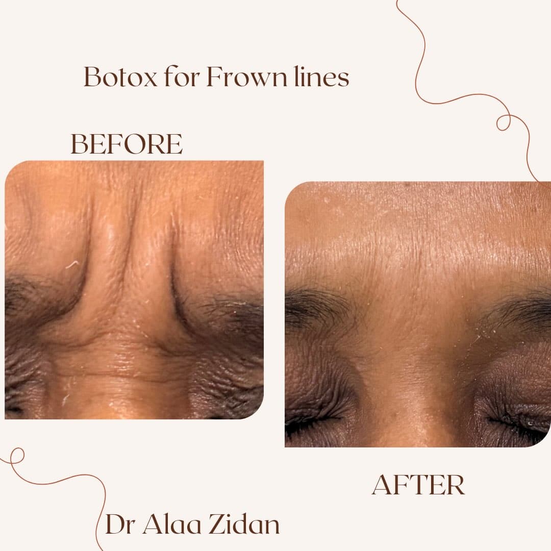 Botox