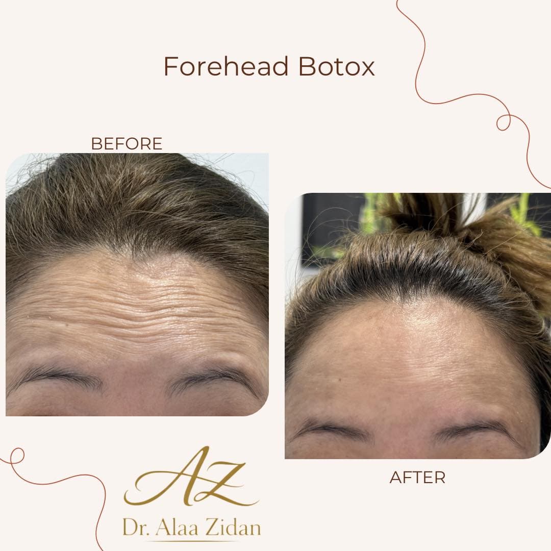 Forehead Botox in the Maldives — A Lighter Approach