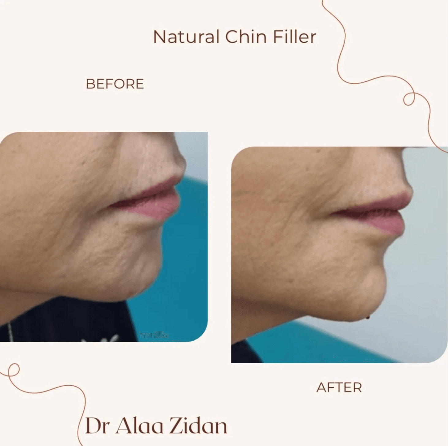 Natural Chin Filler