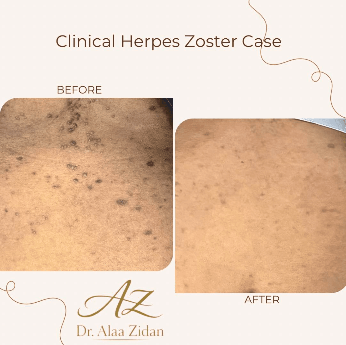 Clinical Herpes Zoster Care