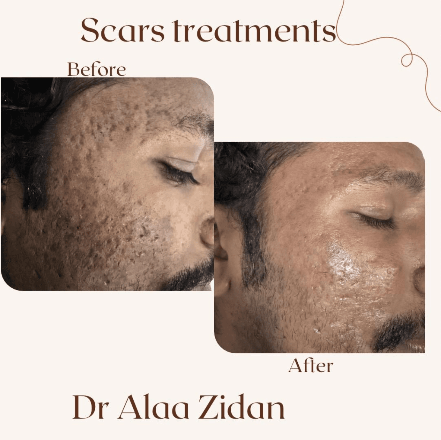 Scars Treatments