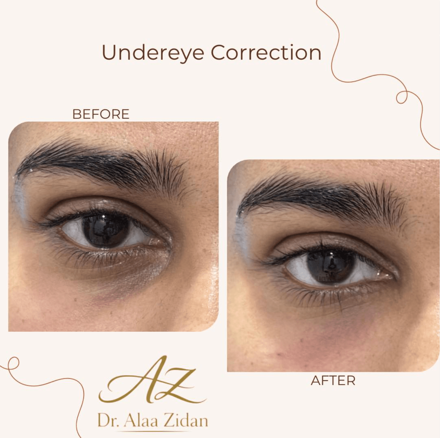 Undereye Correction
