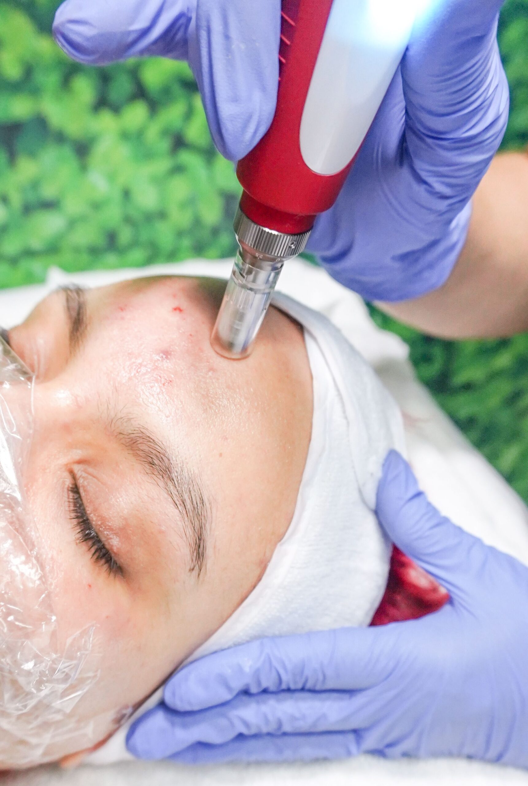 Microneedling in the Maldives: Small Needles, Big Results