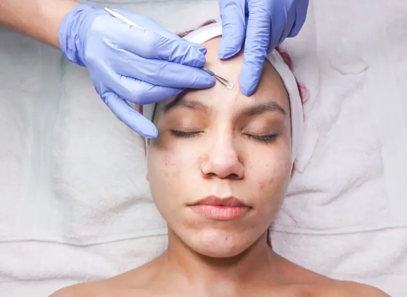 Acne and scar treatment