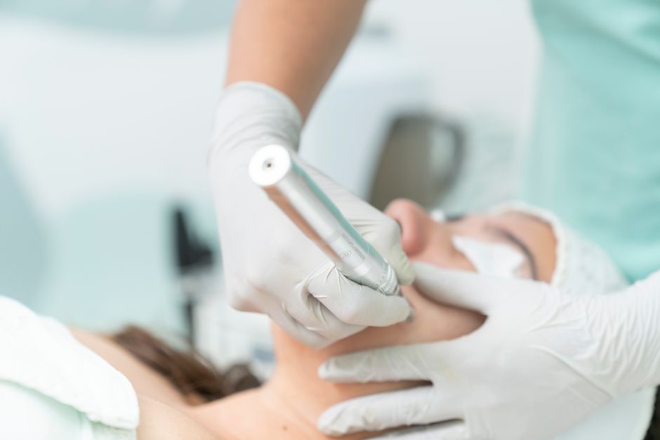 Microneedling for Acne Scars: What Results to Expect
