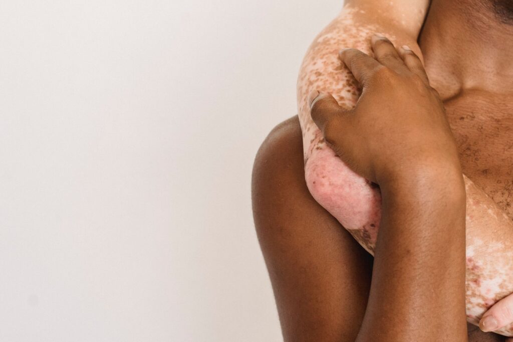 Why Pigmentation and Melasma Are More Common in the Maldives