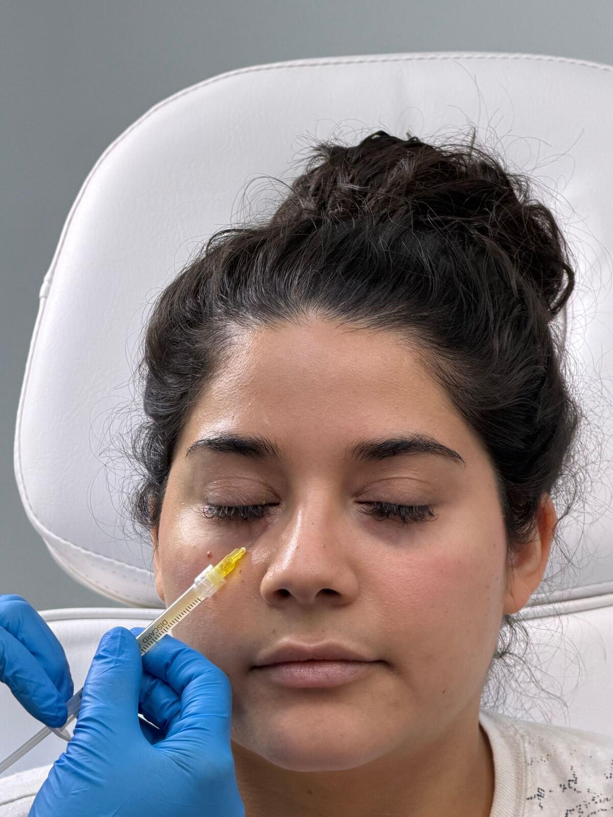 Tear trough under-eye filler injection being performed in Maldives