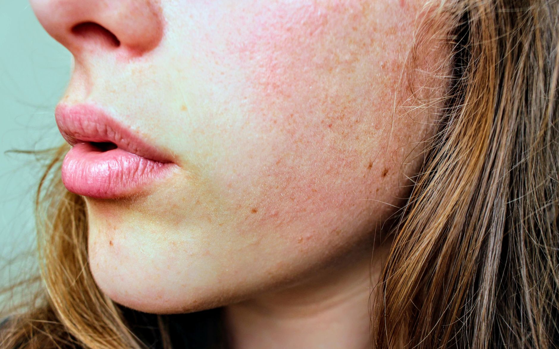 Melasma Treatment: What Actually Works