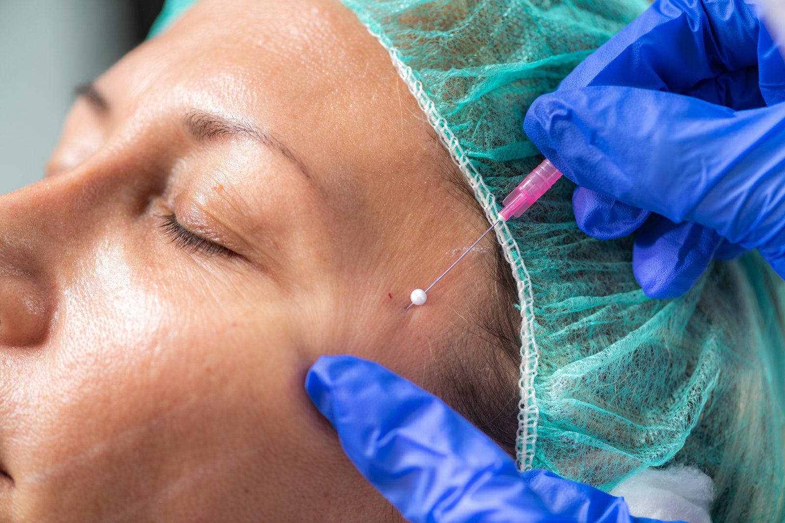 A patient receiving a tear trough filler treatment to the under-eye area