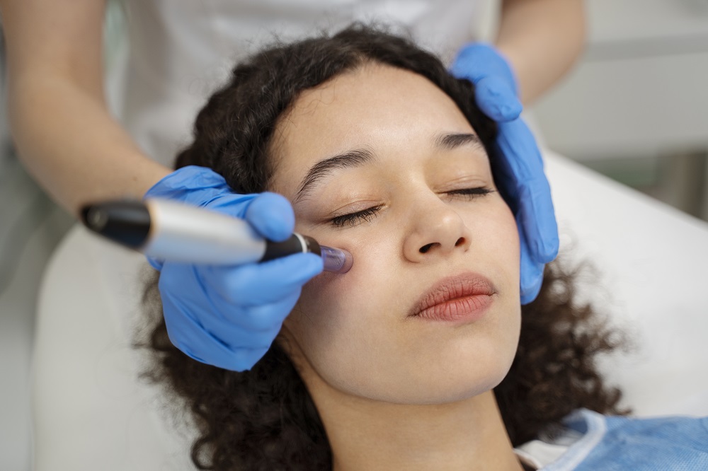Microneedling treatment at Dr. Alaa Zidan clinic