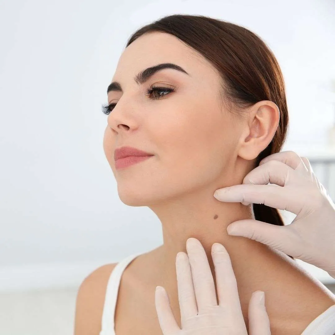 Skin Tag Removal treatment at Dr. Alaa Zidan clinic