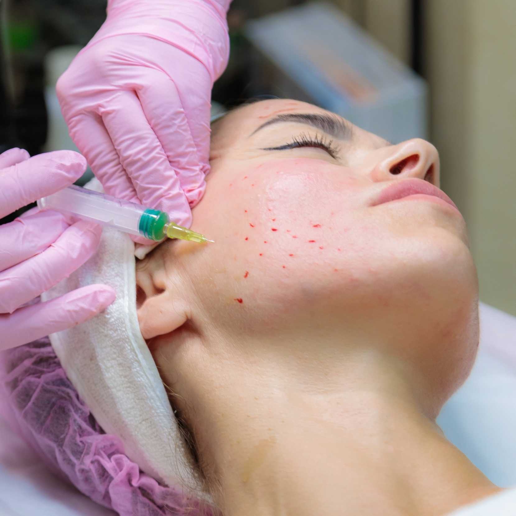 PRP & PRF Facial Rejuvenation treatment at Dr. Alaa Zidan clinic