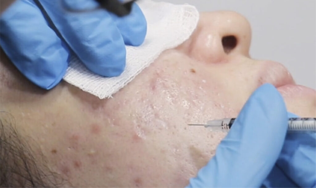 TCA Cross treatment at Dr. Alaa Zidan clinic