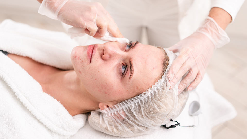 Acne & Scars treatment at Dr. Alaa Zidan clinic