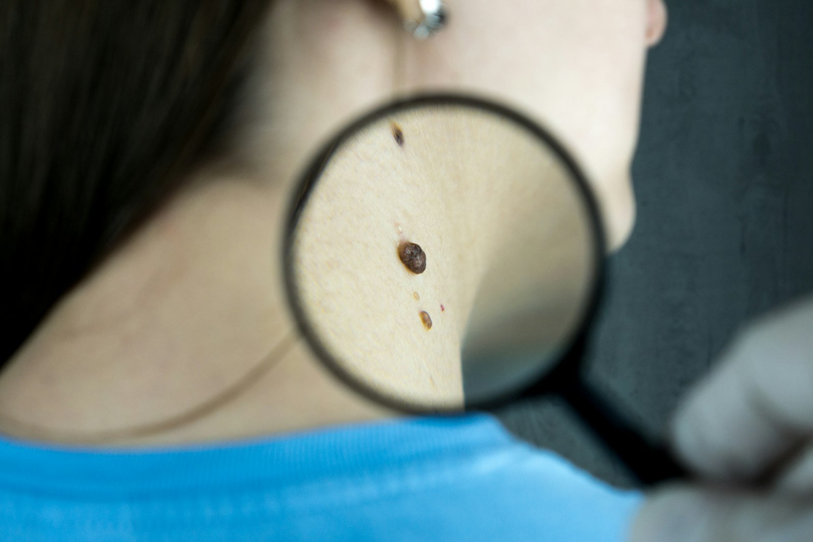 A dermatologist assessing acne scarring before choosing a treatment - Dr. Alaa Zidan, Maldives