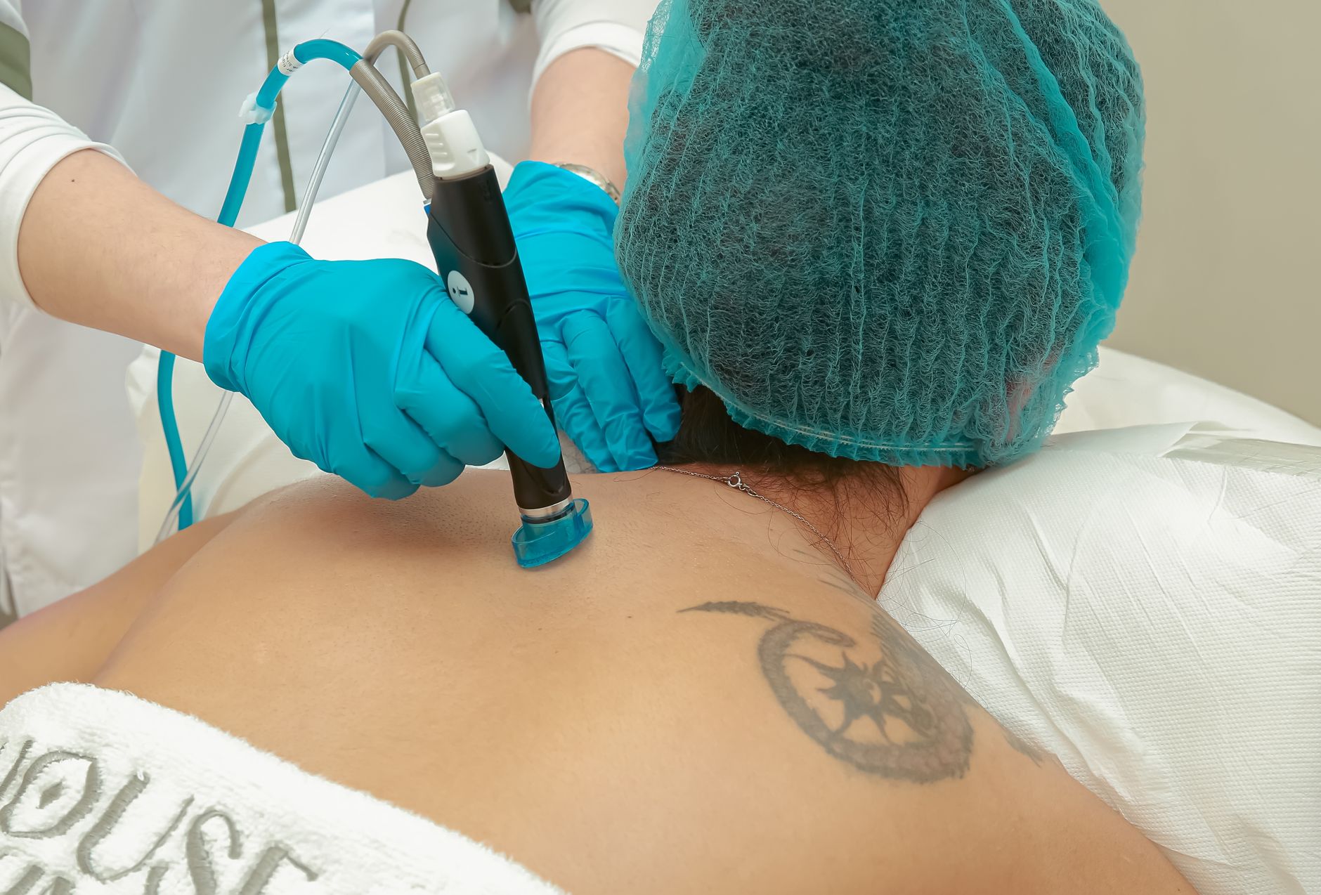 Tattoo Removal Laser treatment in Maldives