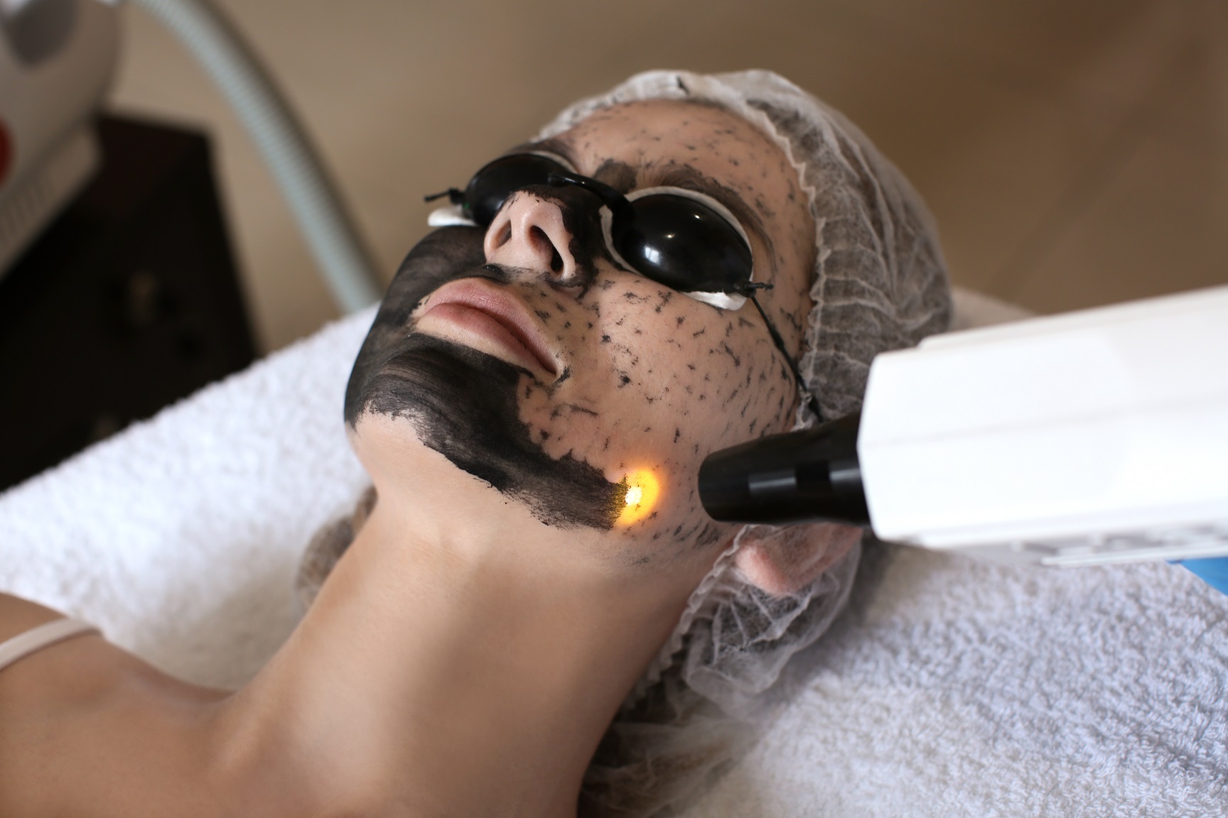 Carbon Laser Peel treatment at Dr. Alaa Zidan clinic