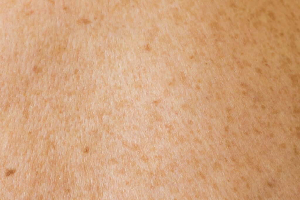 Acne Treatment Guidelines Updated: What Changed for 2026