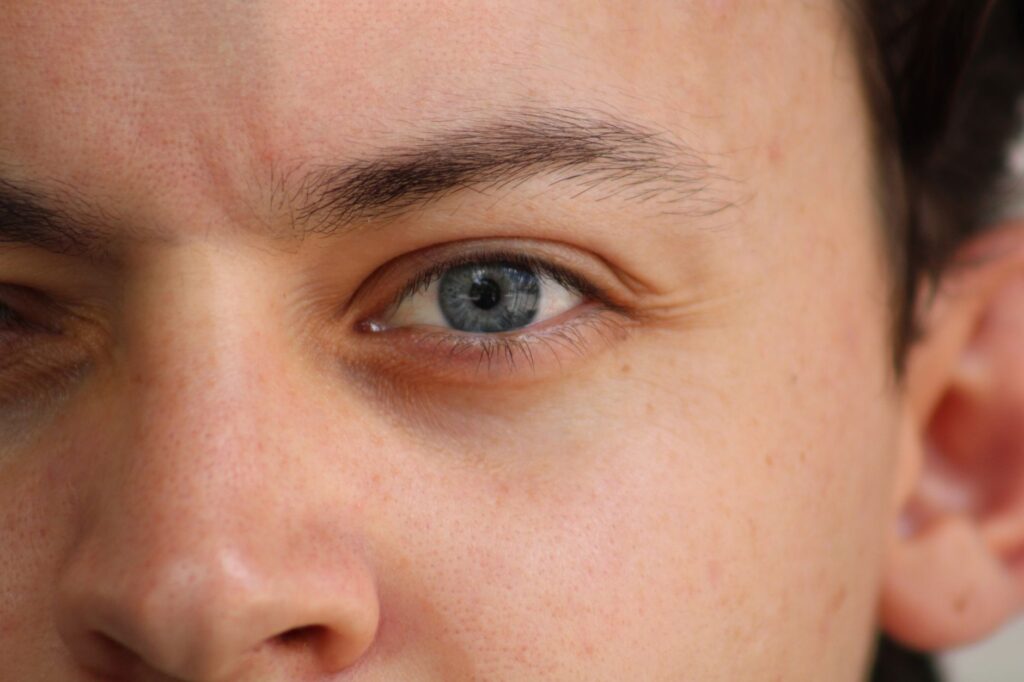 Q-Switched Laser in the Maldives for Pigmentation and Tattoo Ink