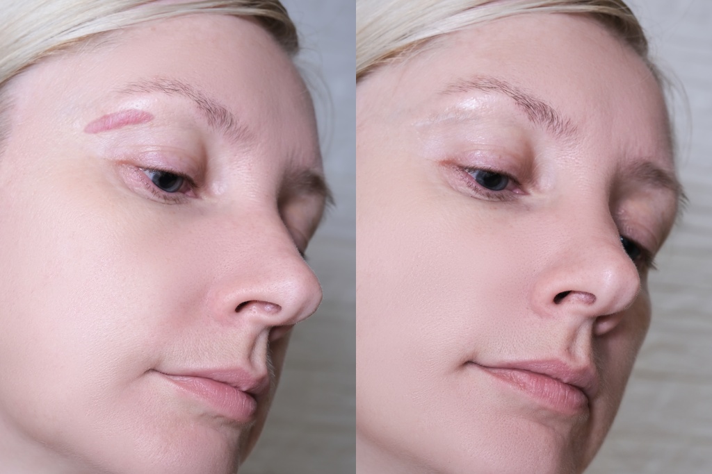 Keloid & Hypertrophic Scar Treatment treatment at Dr. Alaa Zidan clinic