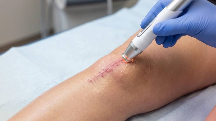 Scar Management treatment at Dr. Alaa Zidan clinic
