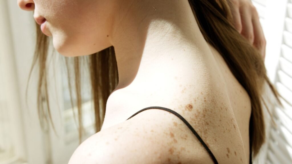 Acne Mark Treatment in the Maldives: Why Post-Inflammatory Hyperpigmentation Lingers
