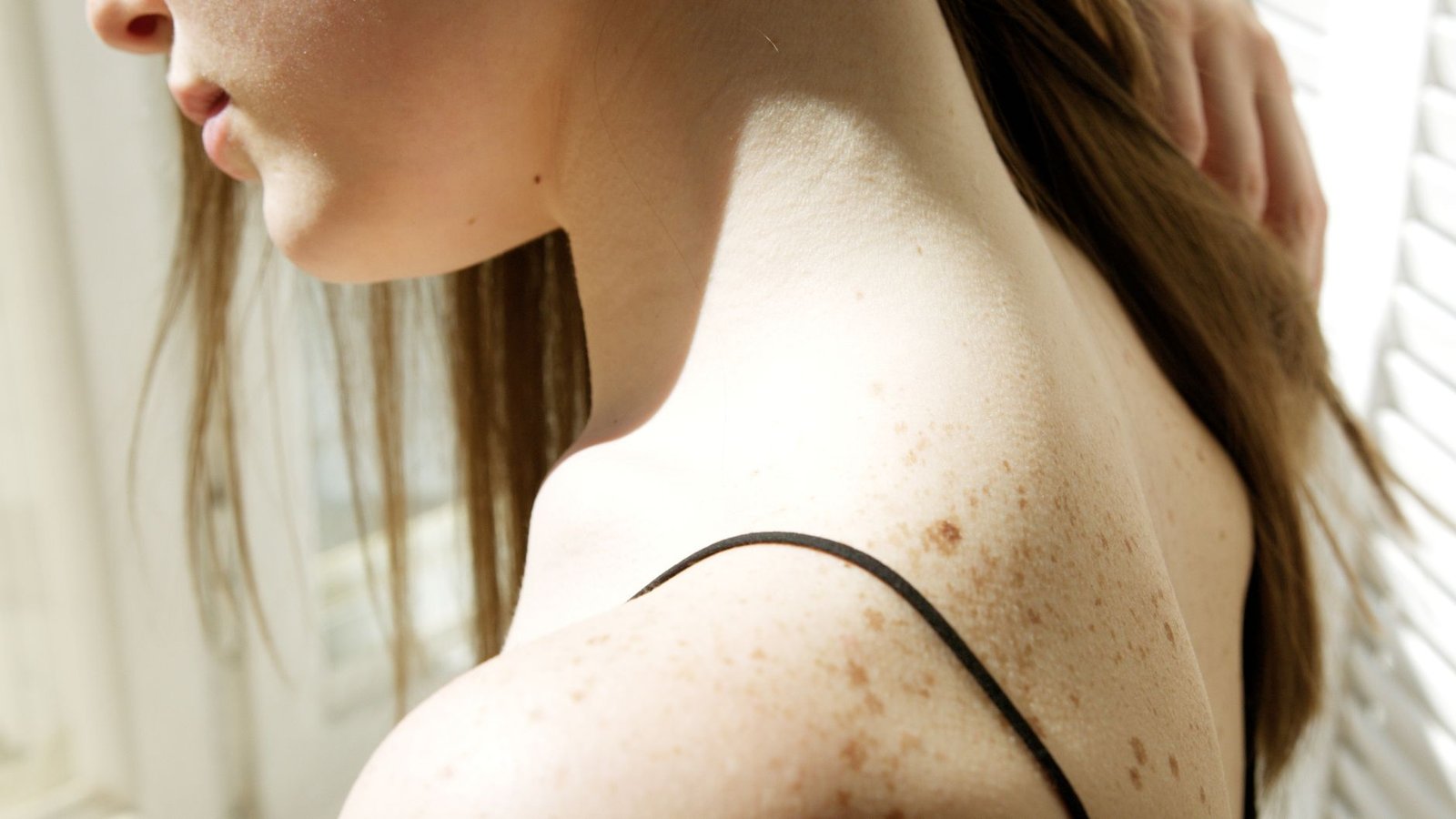 Acne Mark Treatment in the Maldives: Why Post-Inflammatory Hyperpigmentation Lingers