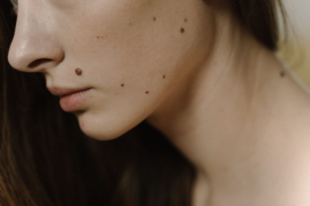 Restylane Contour: FDA Approves New Filler for Temple Hollowing