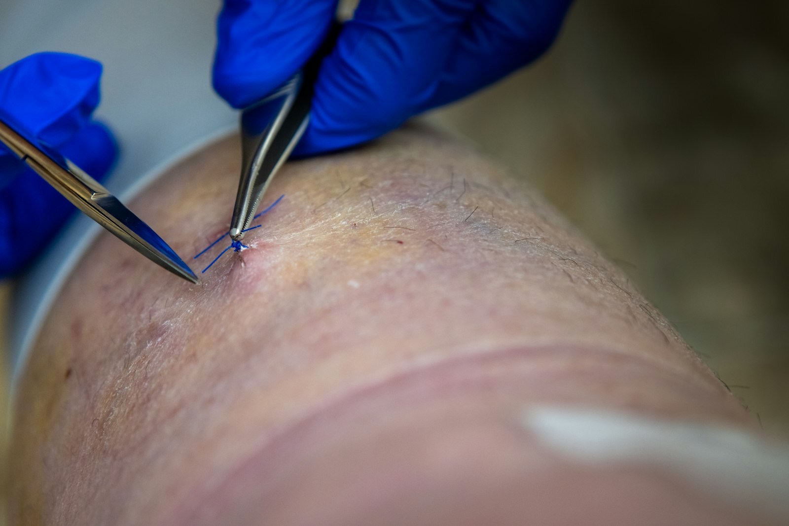 Skin tag removal Maldives is quick and best done professionally, not at home