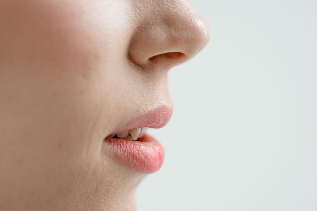 TCA CROSS for Ice-Pick Acne Scars in the Maldives