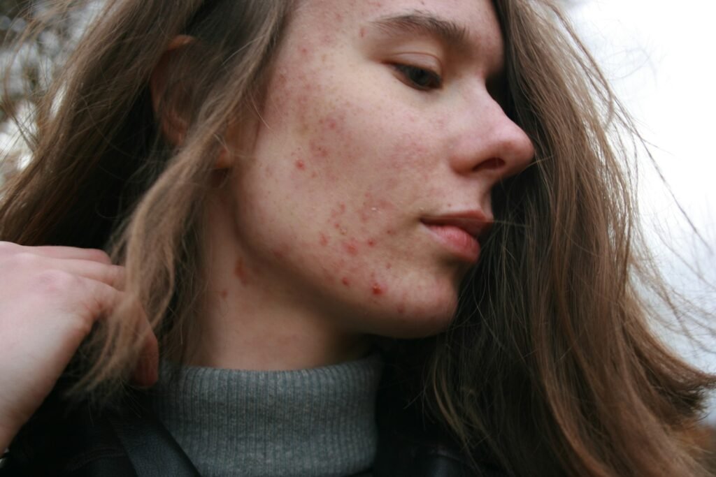 Best Treatment for Acne Scars: A Complete Overview by Scar Type